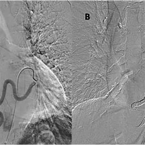 Transcatheter Arterial Embolization For Aorta To Pulmonary Artery