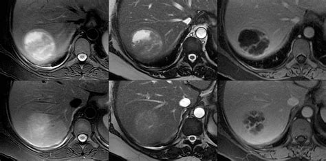 Focal Liver Lesion Characterization Body Mri