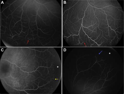 Widefield Fluorescein Angiography In The Fellow Eyes Of Patients With Presumed Unilateral