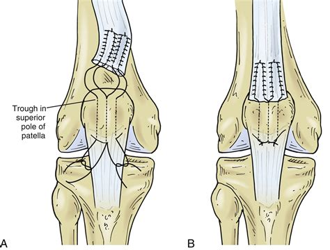 Surgical Treatment Of Traumatic Quadriceps And Patellar Tendon Injuries