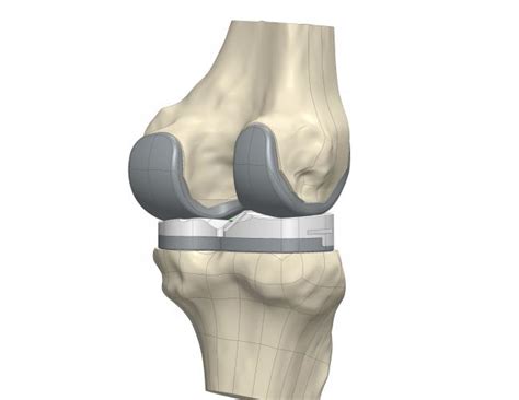 Conformis Springhill Medical Center