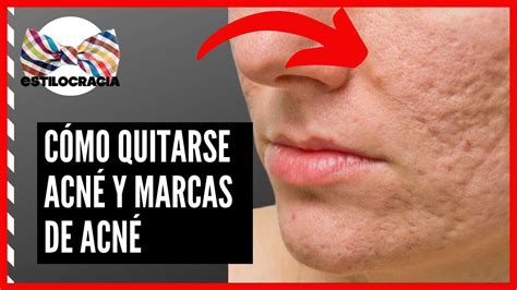 CÓMO QUITARSE MARCAS DE ACNÉ Y ACNÉ 7 TRUCOS PARA QUITARTE LO CACARIZO