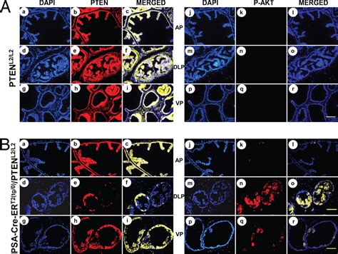 Temporally Controlled Ablation Of Pten In Adult Mouse Prostate