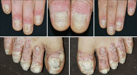 How To Treat Psoriasis Of The Nail Bed - Nail Ftempo