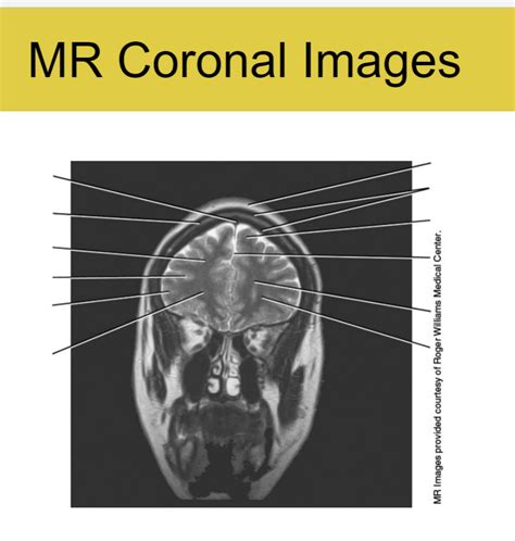 Mr Coronal Image 1 Diagram Quizlet