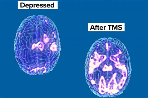 Transcranial Magnetic Stimulation Headworx Clinic