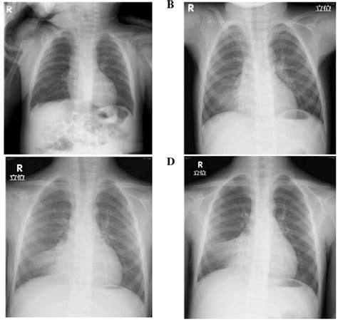 Serial Chest X Rays Of The Patient X Ray Images At A One B Three