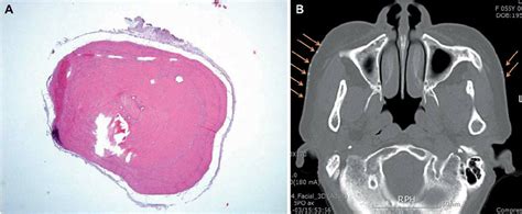 A Histological Examination Of The Punch Biopsy Shows A Small Spicule