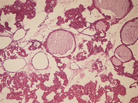 A Encapsulated Microfollicular Adenoma He Stain ×200 B