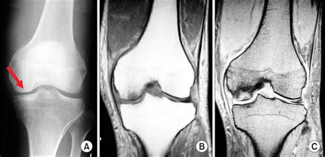 Subchondral Insufficiency Fractures Of The Femoral Head