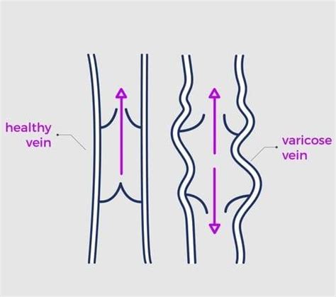 Varicose veins treatment In Jamnagar | Low Cost Sclerotherapy