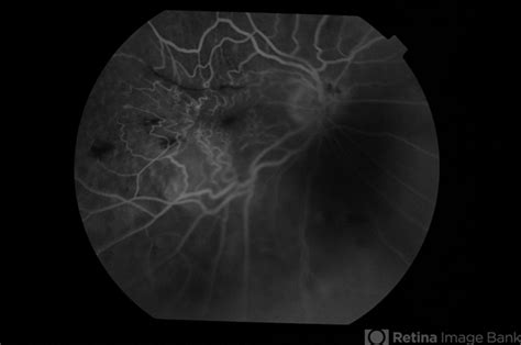 Lignocaine Retinal Toxicity Retina Image Bank