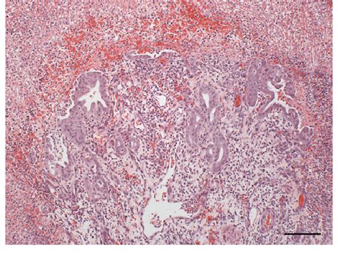 Gall Bladder Wall Histopathology There Is Marked Epithelial