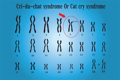 Cme Activity Cri Du Chat Syndrome Mds And Pas