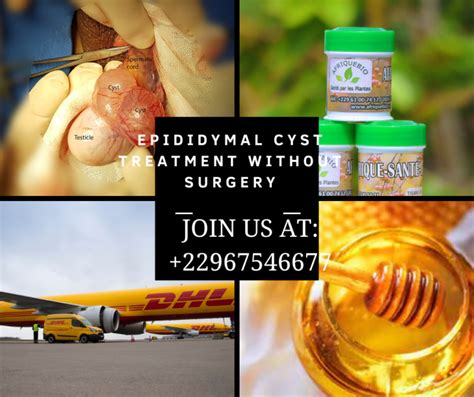 Epididymal Cyst Treatment Without Surgery