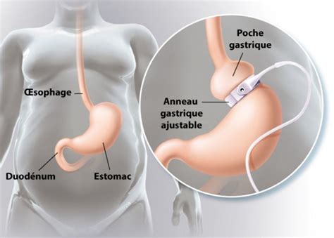 Anneau gastrique prix Tunisie chirurgie d obésité pas cher