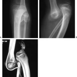 A Plain Radiograph Of The Left Knee Anteroposterior View B Plain