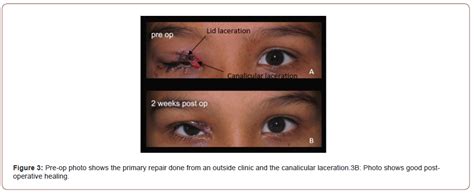 Secondary Repair Of Upper Lid Laceration With Canalicular Laceration Right A Case Report Iris