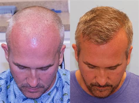 Hair Transplant Results After 6 Months Tiera Danielson