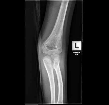 Supracondylar Fracture Radiology Case Radiopaedia Org