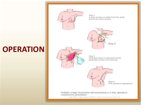 Mastectomy Anatomy