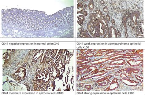 Full Article Cd44 As A Prognostic Marker In Early Colorectal Cancer