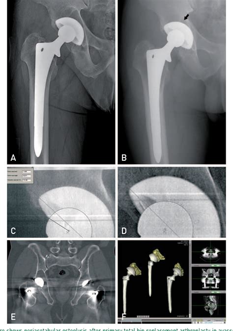 Figure 1 From The Usefulness Of Three Dimensional Computed Tomography As An Assessment Of