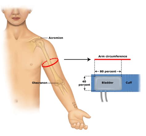 How to select correct cuff size for measuring blood pressure ...