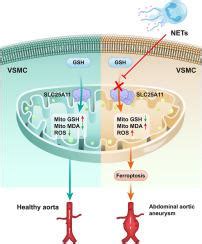 Neutrophil Extracellular Trap Induced Ferroptosis Promotes Abdominal