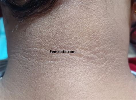 What Is Acanthosis Nigricans Understanding Causes Symptoms