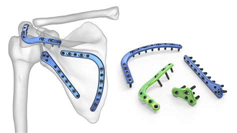 Acumed Scapula Plating System Medical Optical