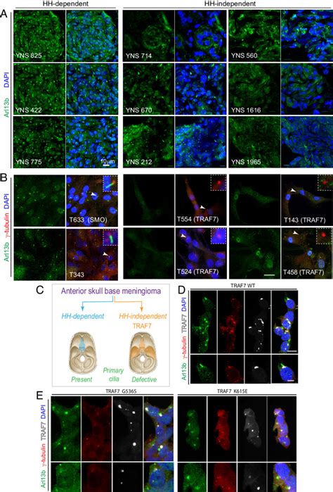 Loss Of Primary Cilia In TRAF7 Driven Meningiomas A Meningiomas That