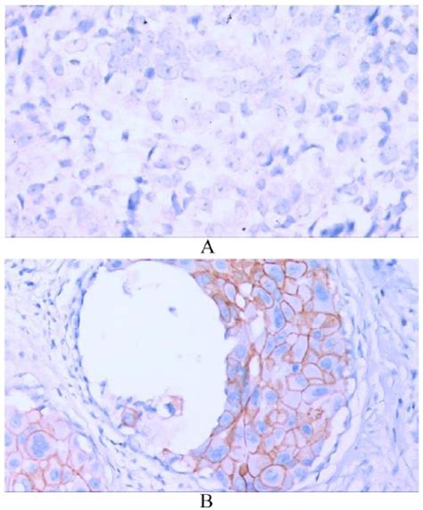 A Negative Vimentin Staining For Tumor Cells With Positive Staining