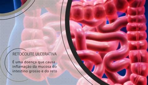 Você sabe o que é Retocolite Ulcerativa Portal da Coloproctologia