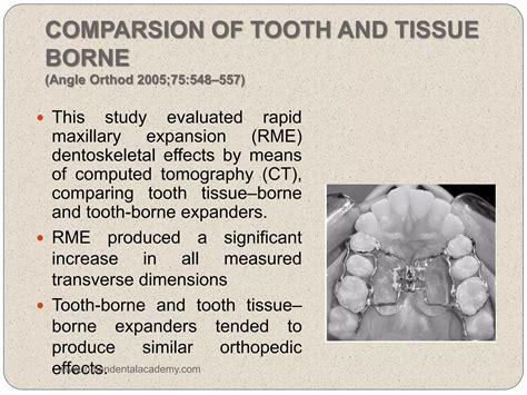 Rapid Maxillary Expansion In Orthodontics Ppt