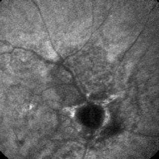 Late Phase Fluorescein Angiography Of Right Eye Showing Stippled