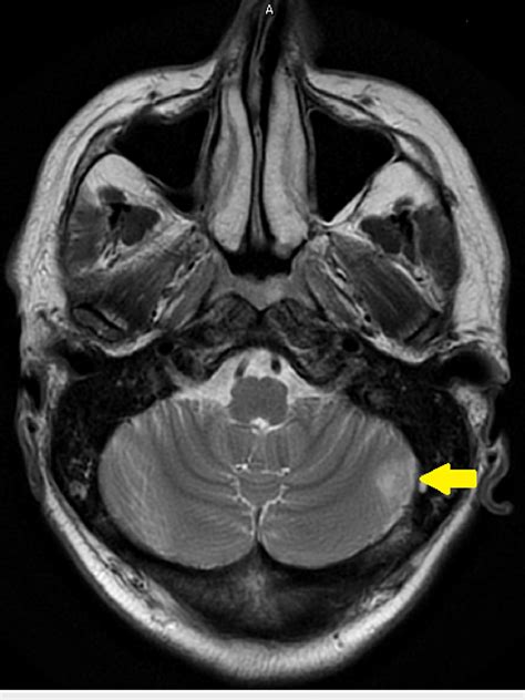 Mri Brain With Contrast Showing A Non Enhancing Mass Like Lesion In The