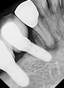 Root Canal Apicoectomy - Before & After Pictures - THE FAVOUR DENTAL