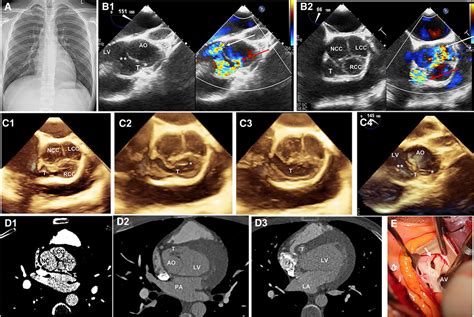 Three Dimensional Transesophageal Echocardiography Visualization Of