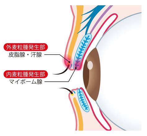 麦粒腫ものもらいはストレスが原因の可能性があります｜大阪鶴見まつやま眼科｜麦粒腫ものもらい・霰粒腫原因と対処法