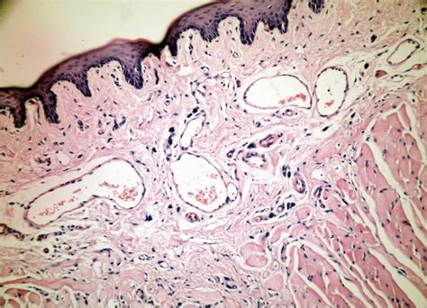 Group 2 3 Ej Thin Light Hyperkeratosis And Surface Epithelium