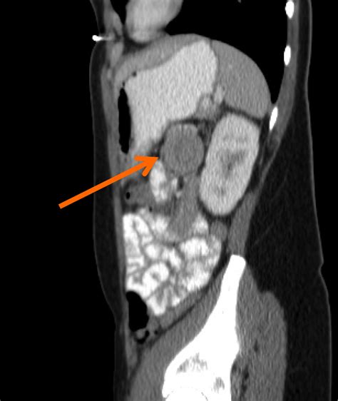 Ct Scan Sagittal View Showing The Target Sign Orange Arrow Download Scientific Diagram