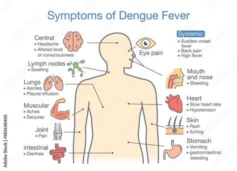 Symptoms Of Dengue Fever Patient Illustration About Diagram For Health