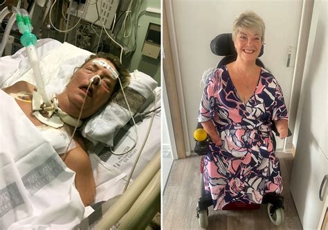 Woman has all of her limbs amputated after developing sepsis from