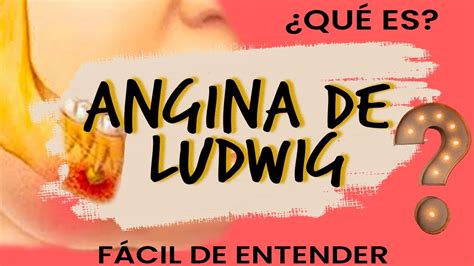 ¿qué Es La Angina De Ludwig Fácil De Entender Diagnóstico Y