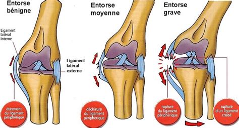 Traitement des entorses et ostéopathie