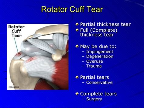 Rotator Cuff Tears Exam