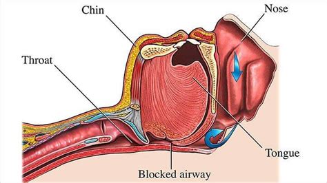 Dentist S Role In Sleep Apnea Treatment News Dentagama