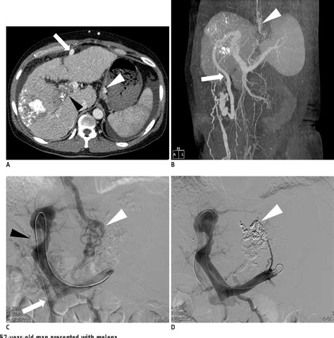 Figure 1 From Percutaneous Access Via The Recanalized Paraumbilical Vein For Varix Embolization