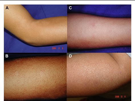 Mild Polymorphic Light Eruption